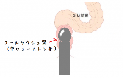 大肛門大学｜第86講 通人のための腸洗滌【2】 -