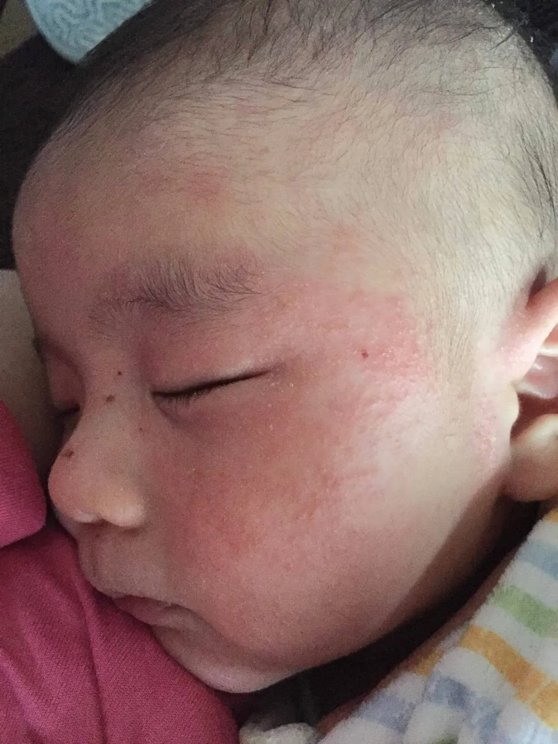 カサカサしたオデコや顔や頭の発疹野田市 小児科 千葉県 こどもの花粉症 こどもの漢方 喘息 アトピー性皮膚炎 アレルギー 結節性痒疹たんぽぽこどもクリニック