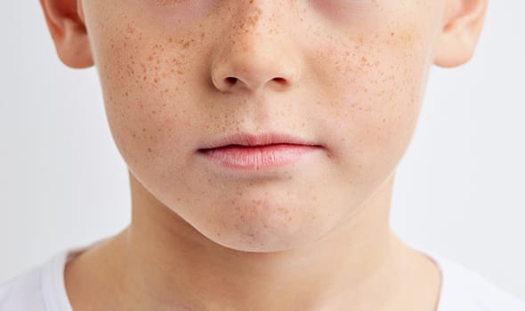 そばかすの原因を教えて！子供もできる予防対策も紹介します！ - トラブルブック