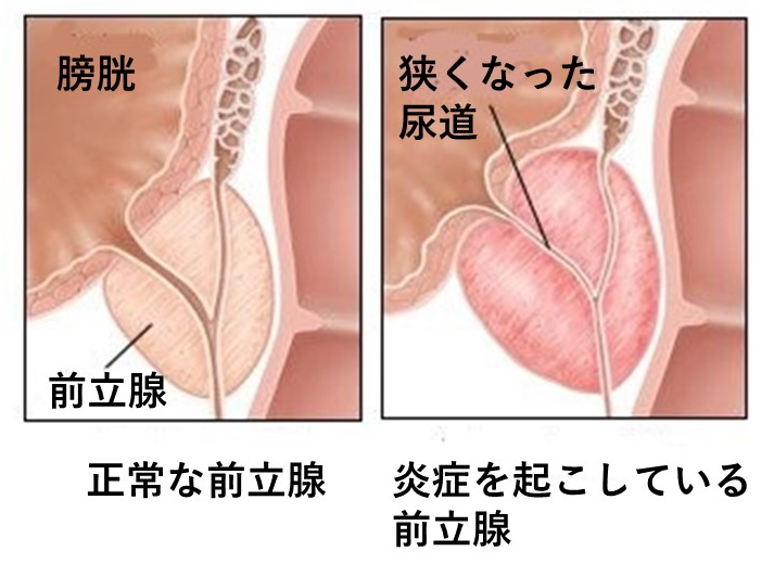 前立腺炎（慢性前立腺炎） | 慢性痛治療の専門医による痛みと身体のQ＆A