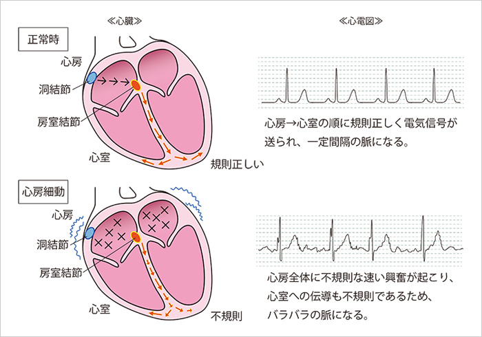 第５回＜読み方・対応編③＞心房細動（AF） | ナース専科