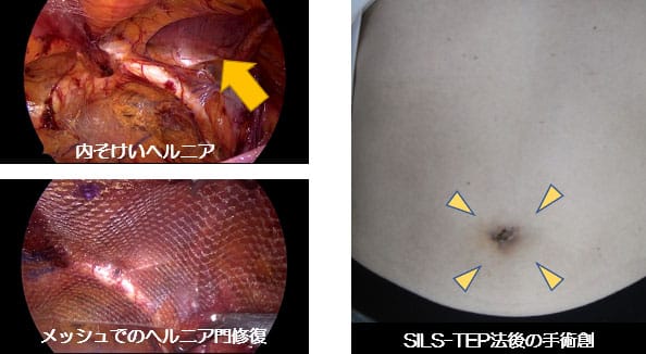 性器ヘルペス（陰部にブツブツがたくさんできて痛いです）-大和クリニック-木更津市の泌尿器科、皮膚科 -