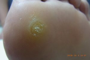 ウイルス性いぼ 尋常性疣贅 神戸市の専門医つかもと形成外科・創傷クリニック