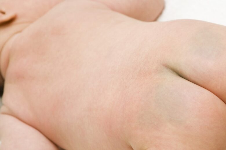 1か月健診 身体のこと体・おしりの青あざ