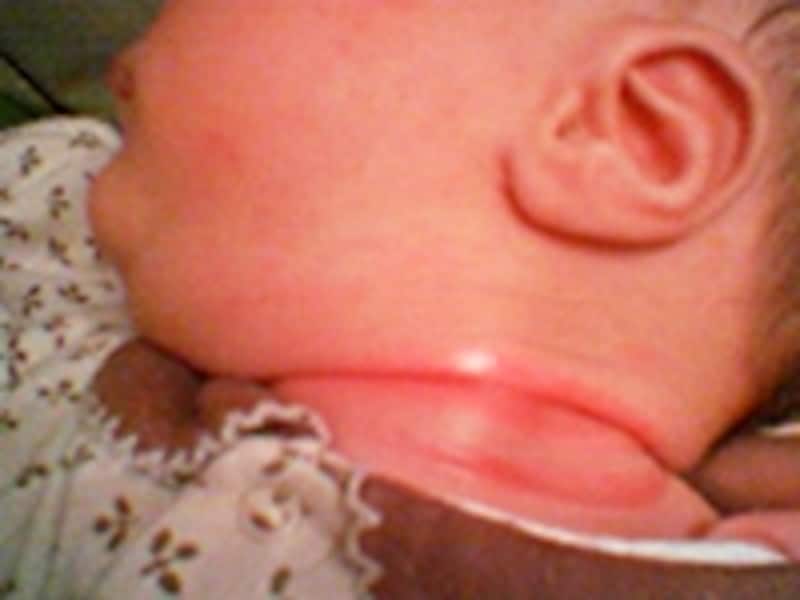 乳児湿疹・アトピー性皮膚炎 発疹・かゆみ・赤み 曙橋駅から徒歩3分、新宿の曙橋よつばファミリークリニック四谷三丁目・牛込柳町駅