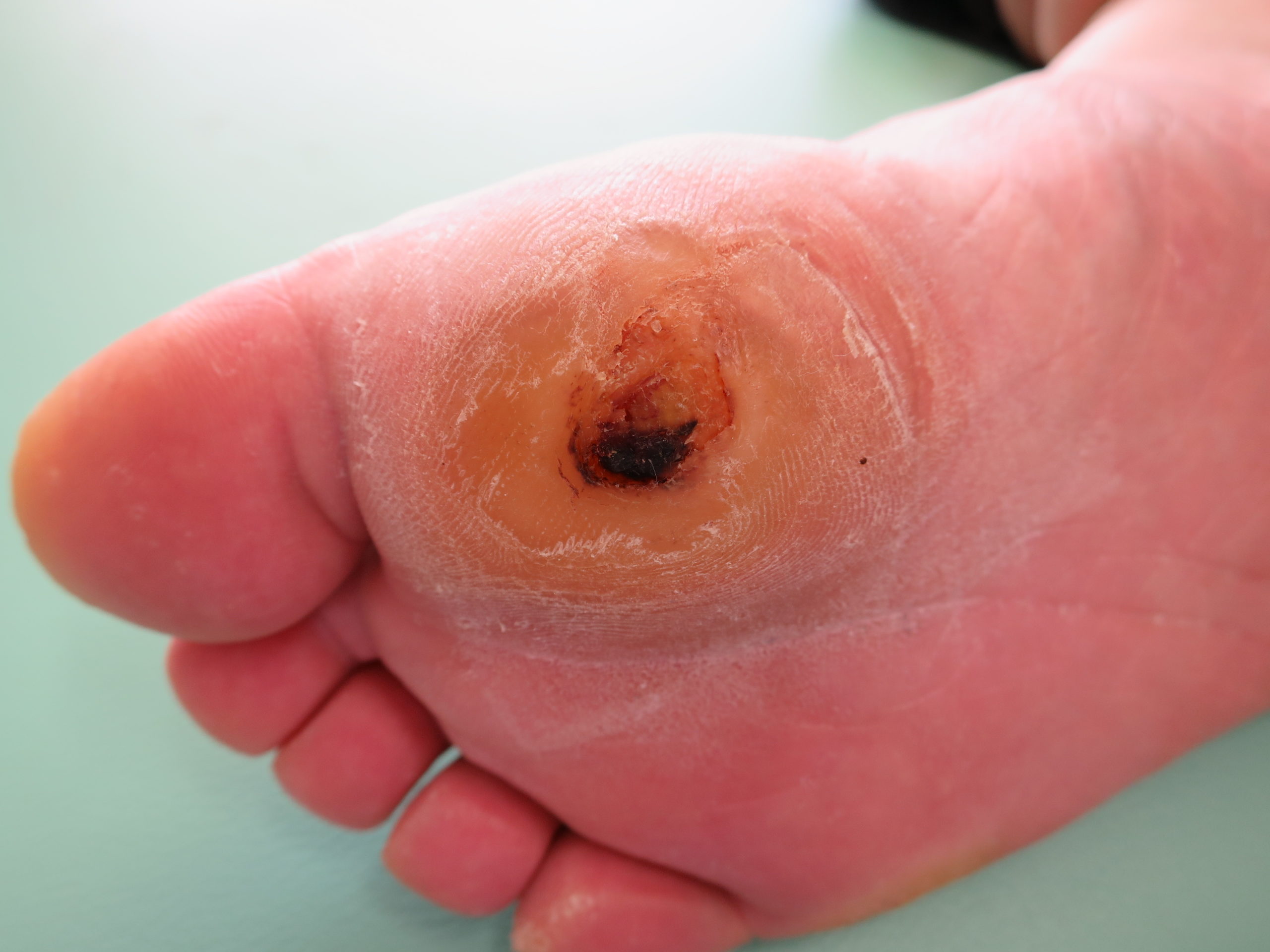 当院でのウイルス性イボの治療のご紹介渋谷スクランブル皮膚科渋谷駅徒歩1分