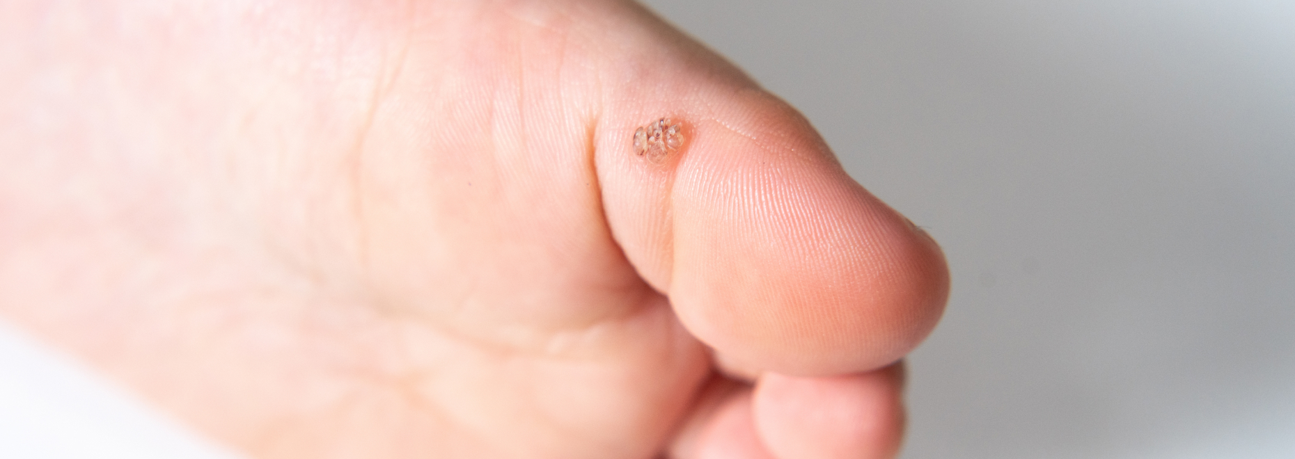 いぼ・水いぼ 子供 の治療川崎市多摩区の稲田堤ひふ科クリニック