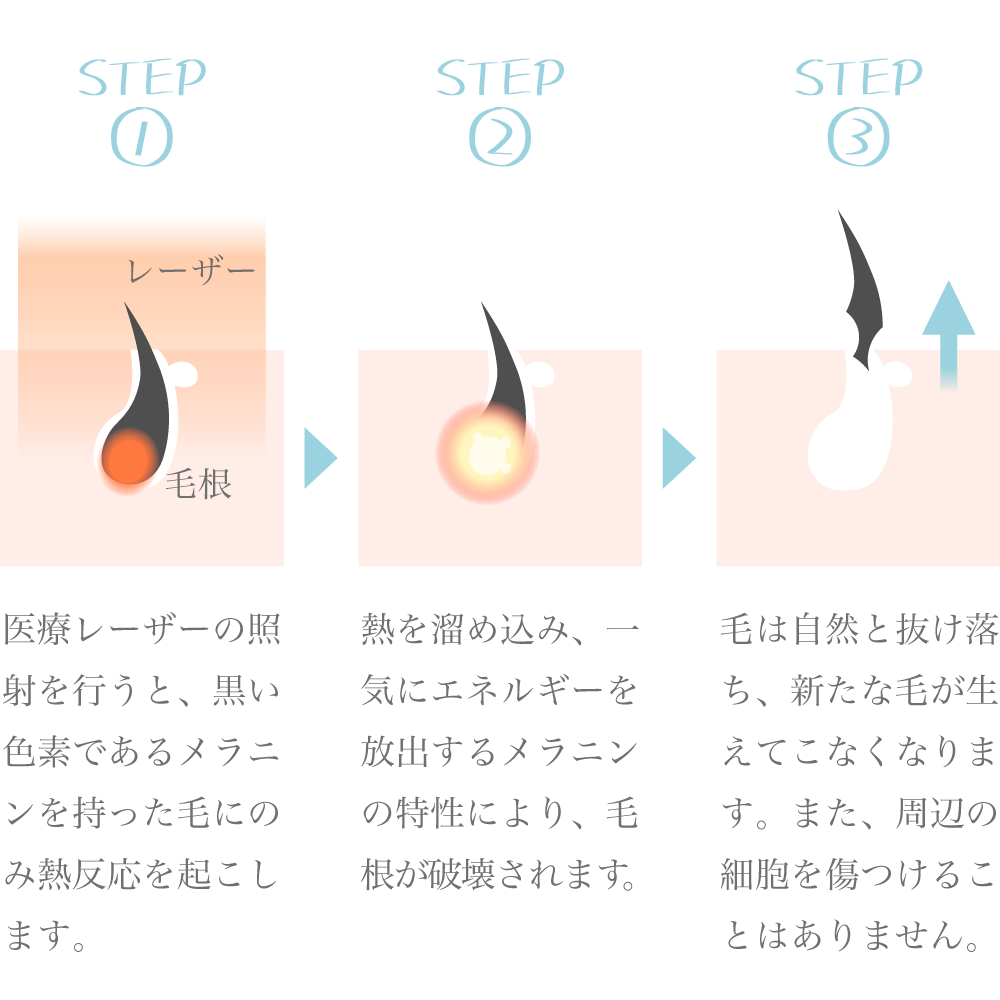 ヒゲ脱毛後に起きる「どろぼうヒゲ」の原因と対策 | メンズ脱毛百科事典 リンクスペディア