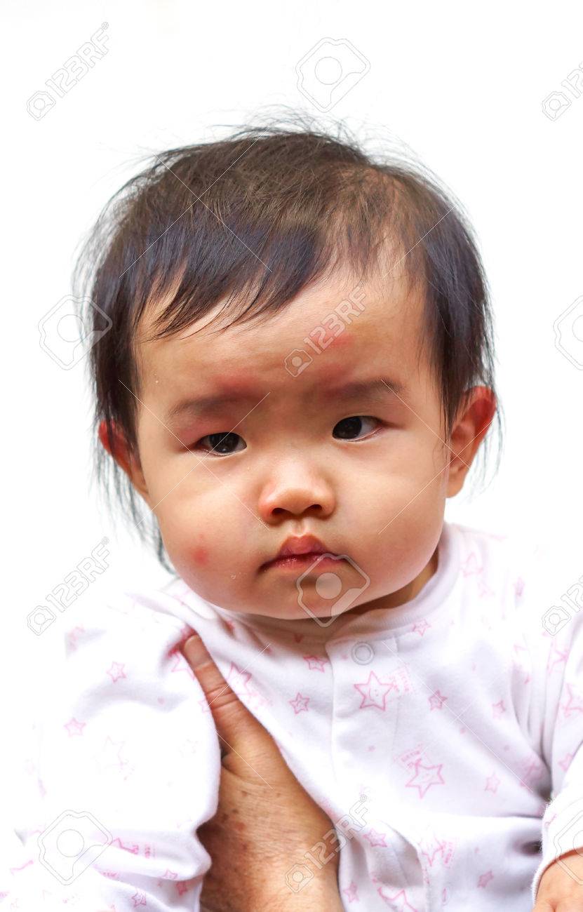 新生児座そう野田市 小児科 千葉県 こどもの花粉症 こどもの漢方 喘息 アトピー性皮膚炎 アレルギー 結節性痒疹 たんぽぽこどもクリニック