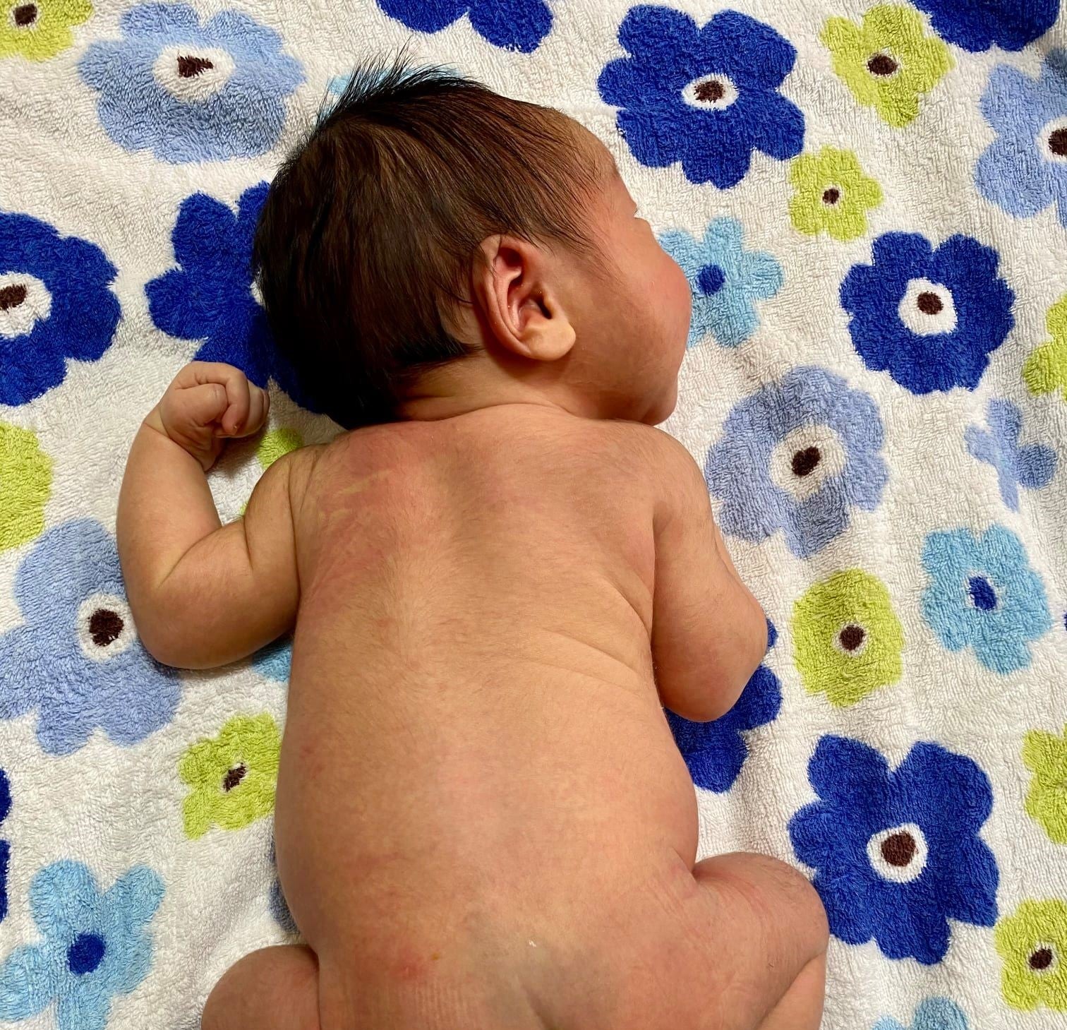 おしりの青いのが消えない」中2の娘の蒙古斑、治療すべき？アスクドクターズトピックス