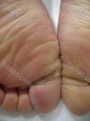 いぼ大田区大森・大木皮膚科 尋常性疣贅・イボ治療専門外来