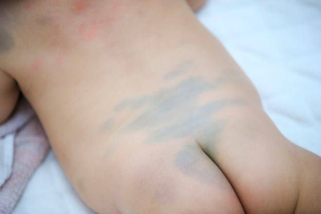 赤ちゃんの蒙古斑 海外では虐待と勘違いされることもヨミドクター 読売新聞