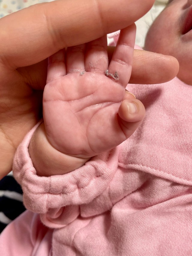 手のひらにホクロができました -よろしくお願いします。 私の友人 男性 が-OKWAVE