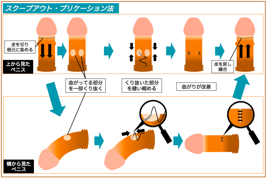 うちの子、むいたほうがいいの？」男の子の性器、むくorむかない問題…判断するポイントを解説！（ベビーカレンダー）