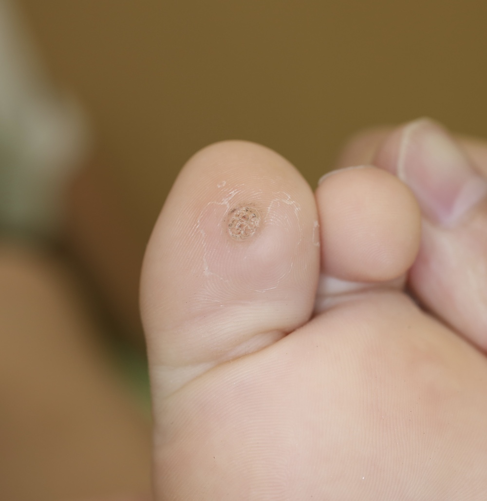 足裏の大きく治療困難なウイルス性いぼ大和駅前いなば皮膚科 旧名：大和駅前皮フ科スキンクリニック