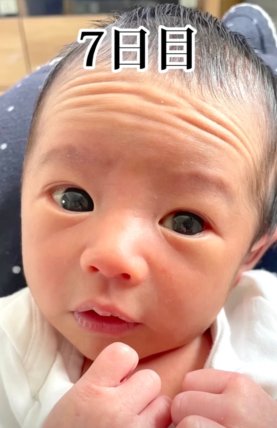 ウンナ母斑の原因は？赤ちゃんの顔にできやすいアザ4種類を比較！赤ちゃん ・子供のあざ治療なら最新レーザー治療×形成外科専門医の大阪梅田形成クリニック