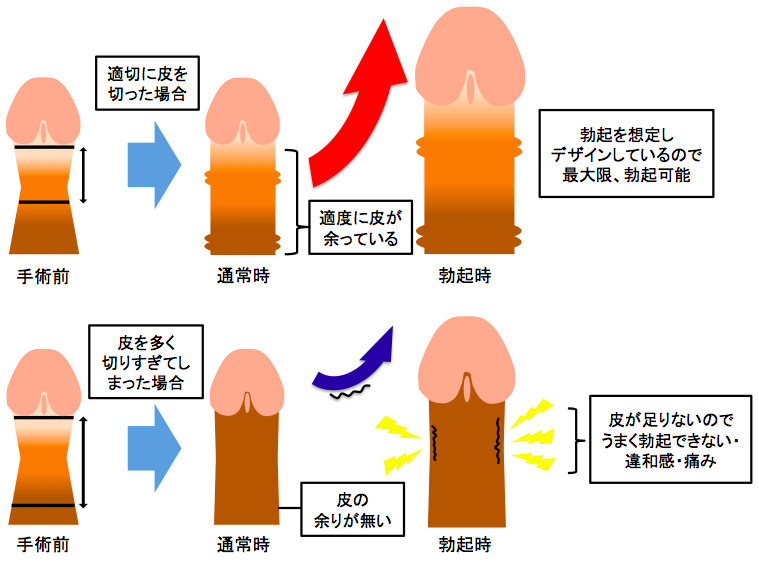 現役医師が解説】包茎手術でペニスの皮を取り過ぎたらどうなる？ – メンズ形成外科 | 青山セレス&船橋中央クリニック