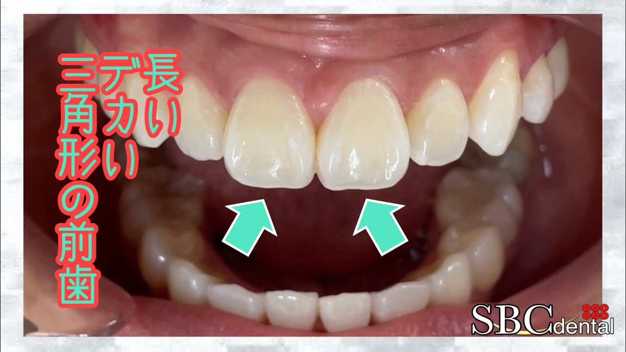 白河れいは前歯が大きすぎてかわいくない？差し歯との噂も徹底調査