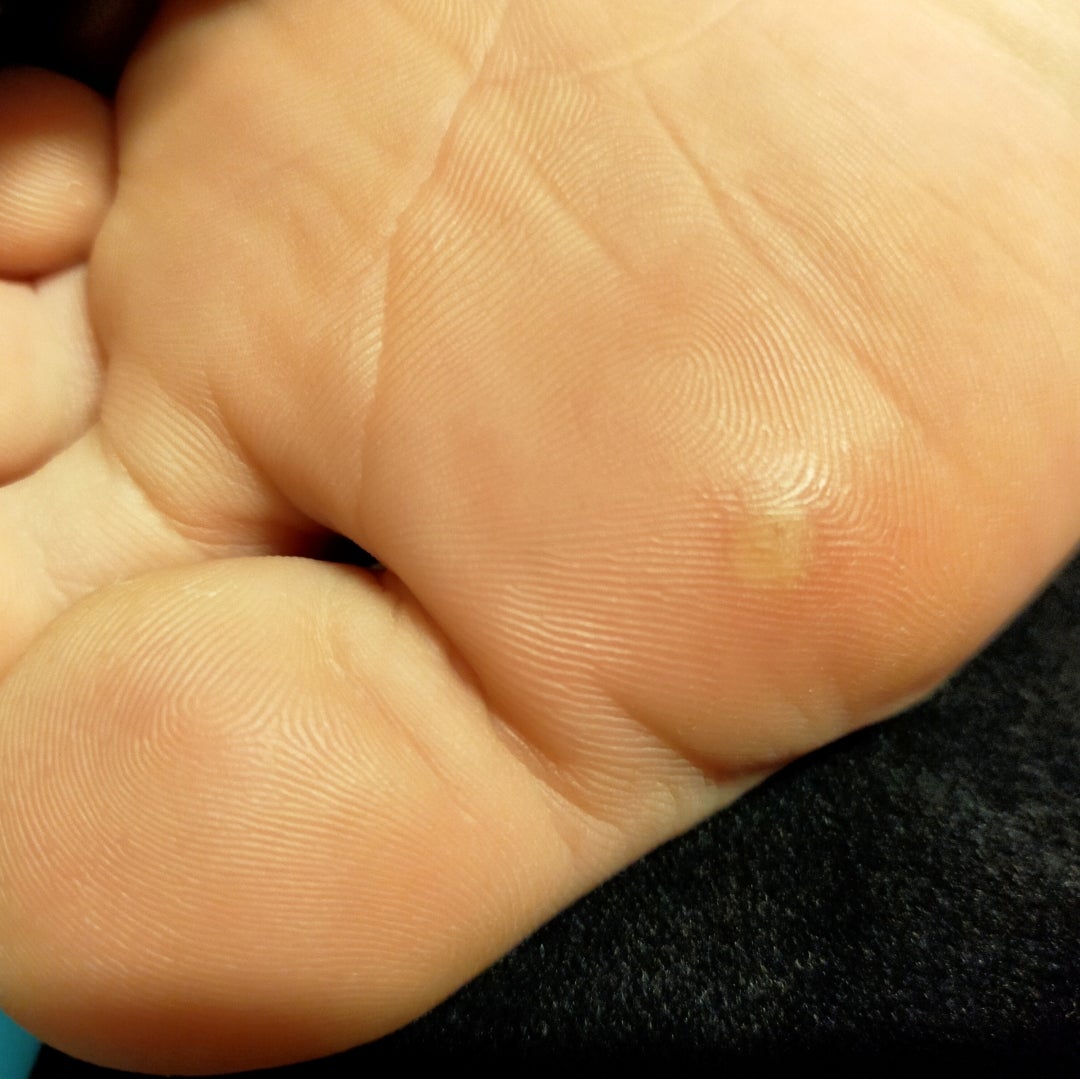 子供のイボはうつる！早期発見で皮膚科へ３人兄妹ママ子育てブログ☆ぽゆき