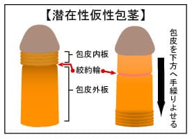 ドリチンとは？ドリチンのデメリットと最善の治療法を徹底解説 | 【フェアクリニック】包茎・薄毛・男の悩み相談所