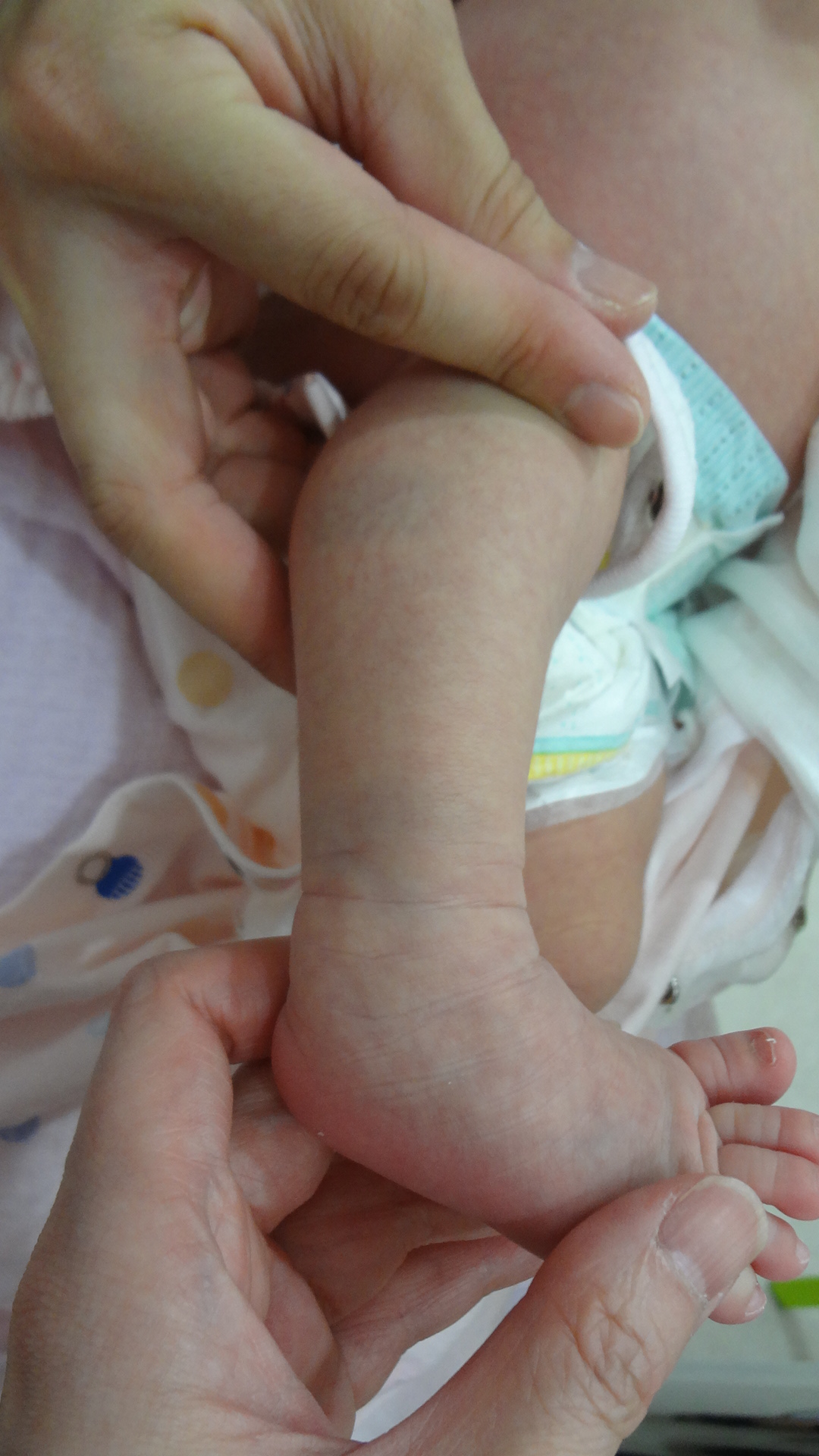 産婦人科医監修 赤ちゃんの蒙古斑、いつ消える？治療は必要？異所性蒙古斑とはキューズベリー抱っこ紐専門店公式ブログ