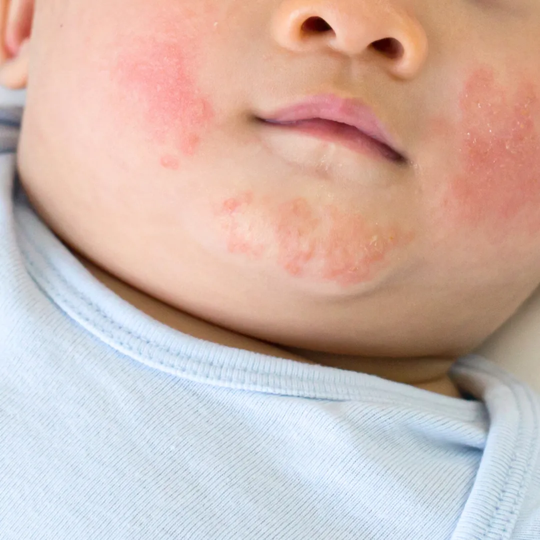 医師監修 赤ちゃんの顔や頭にブツブツが！？新生児に多い「乳児湿疹」 脂漏性皮膚炎 の原因・予防・対処法ナチュラルサイエンス for Mama &Kids Smile