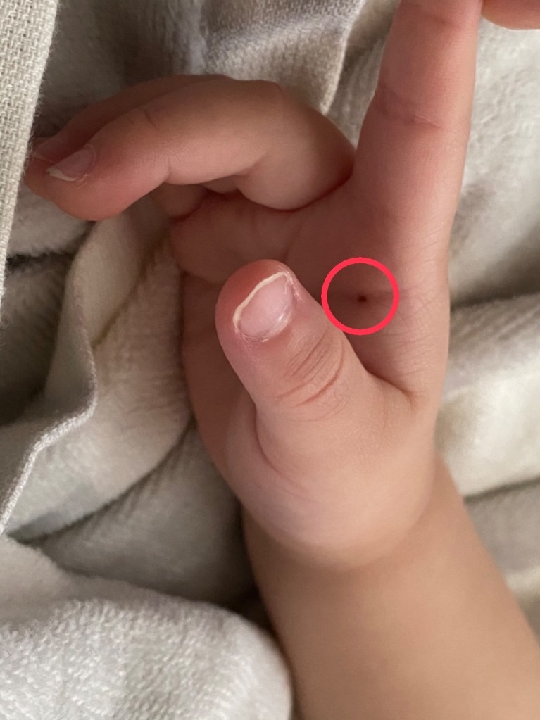 1歳 手の熱傷です。 湿潤療法- 粉瘤 アテロームこおりたひろ整形形成外科クリニック - 痛みの少ない粉瘤治療で多数の実績大阪