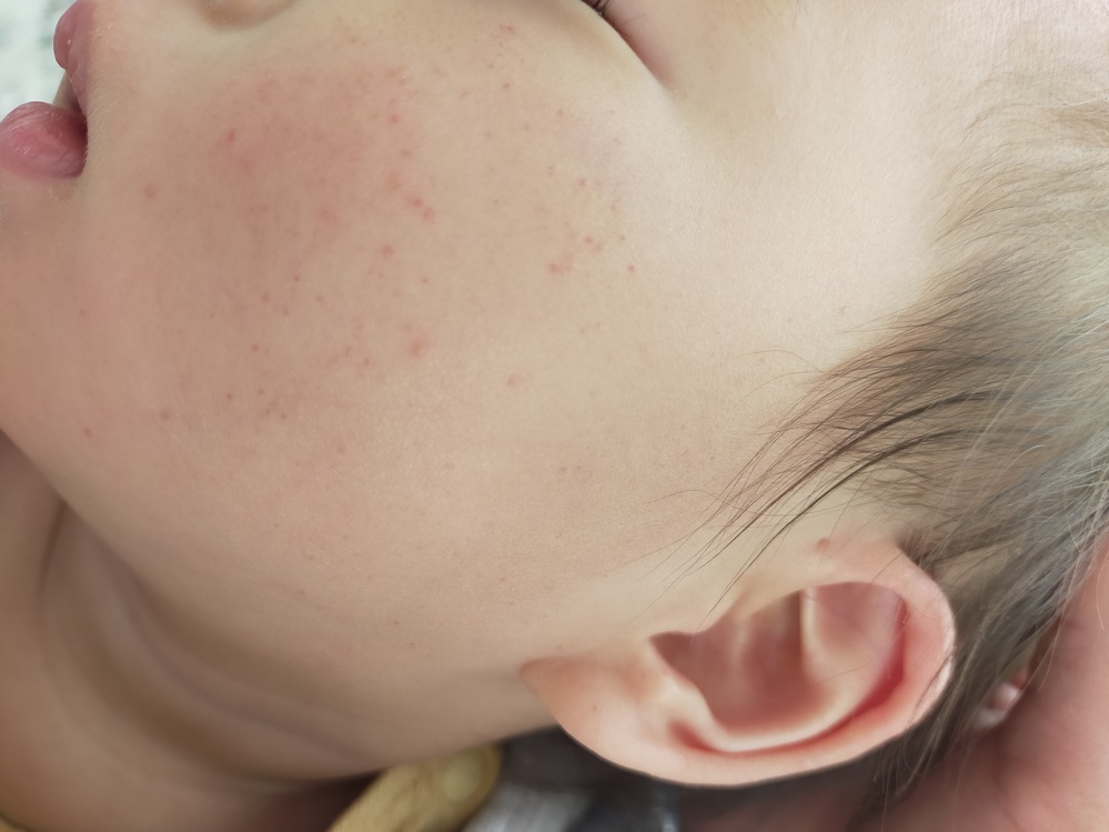 そばかすの原因を徹底解説！子どもの頃からできる理由や具体的な予防法は？ハダメディア by BIHADADO.TOKYO