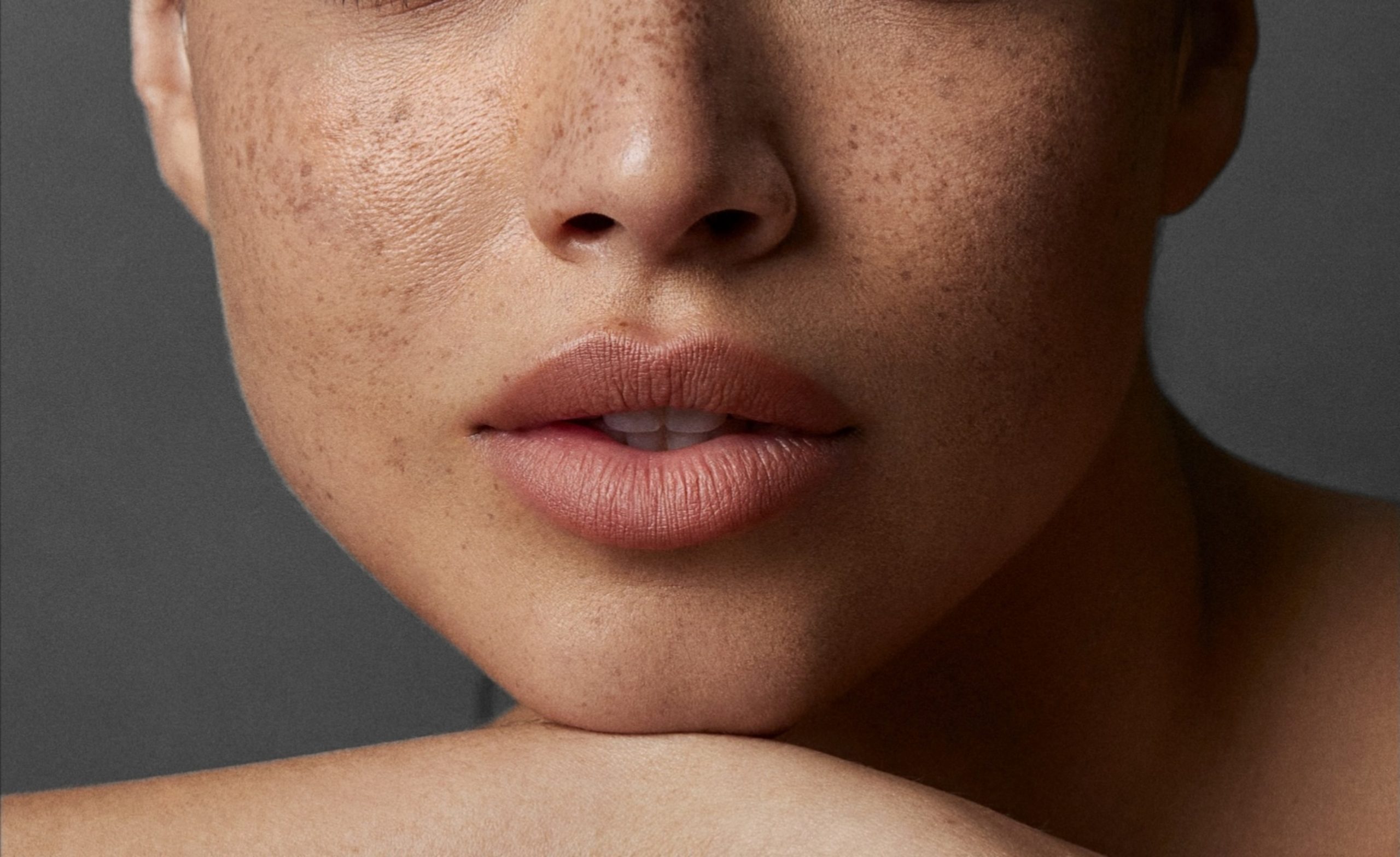 そばかす治療なら名古屋市南区のうらた皮膚科へ